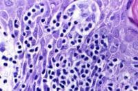 Mycosis fungoides - 