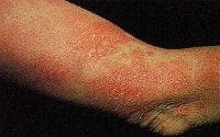 Mycosis fungoides -  