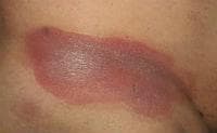Mycosis fungoides -   