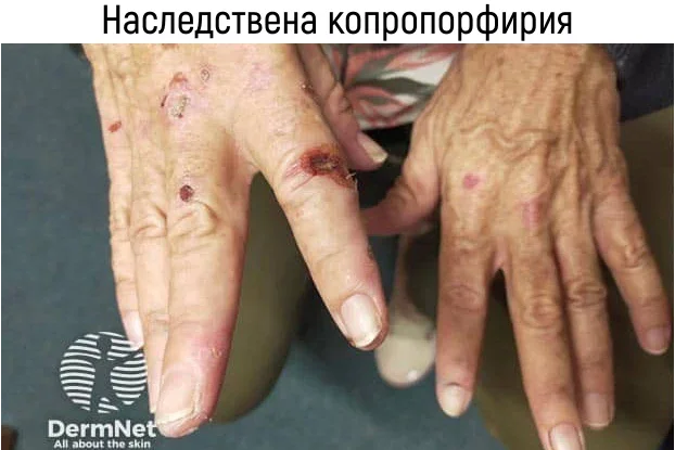 Наследствена копропорфирия Наследствена копропорфирия