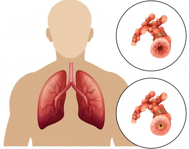 Особености на болестния процес при астма
