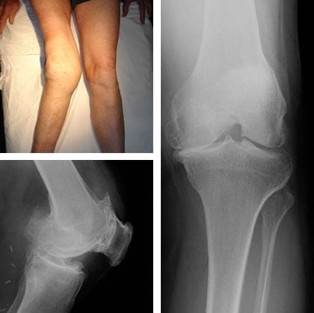artroza posttraumatică a articulației interfalangiene osteochondroza simptomelor bolii articulației genunchiului