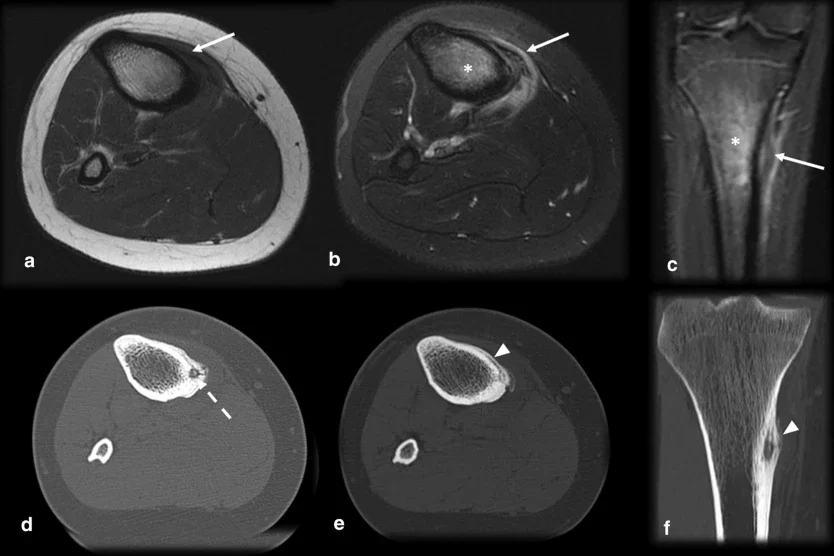 Снимка на остеоид остеом на тибията Снимка на остеоид остеом на тибията