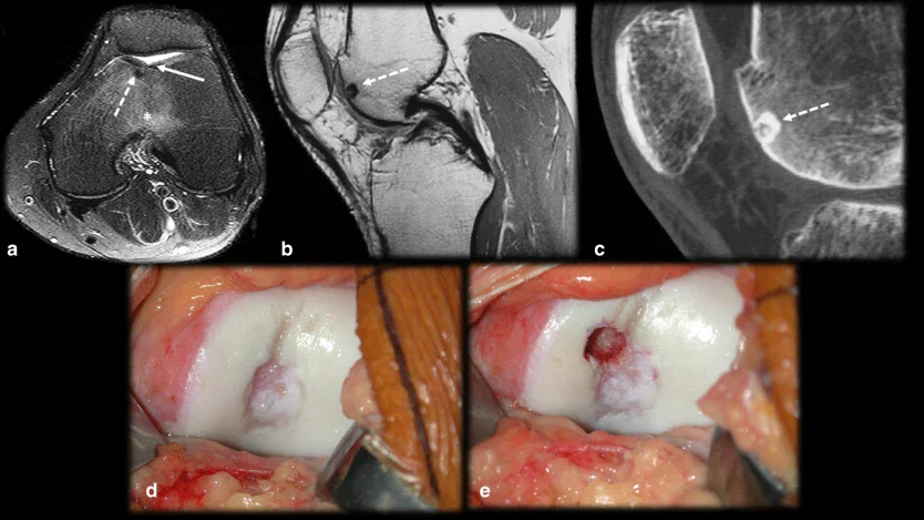 Субхондрален остеоид остеом на коляното Субхондрален остеоид остеом на коляното