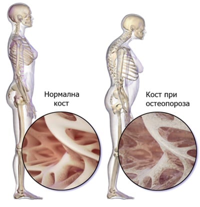 Промени в костите при остеопороза