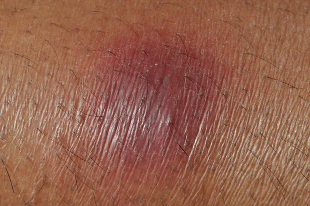 Паникулит Паникулит