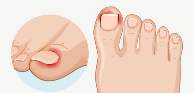 Патофизиология паронихия Патофизиология паронихия