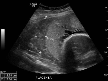 abruptio placentae 