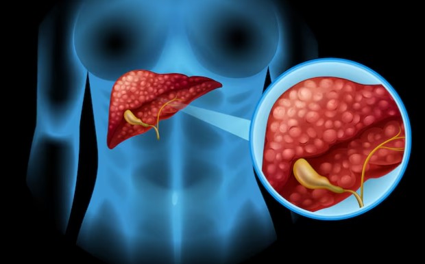 Чернодробна цироза Чернодробна цироза