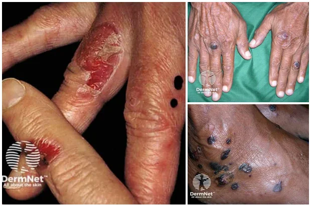 Придобита булозна епидермолиза Придобита булозна епидермолиза