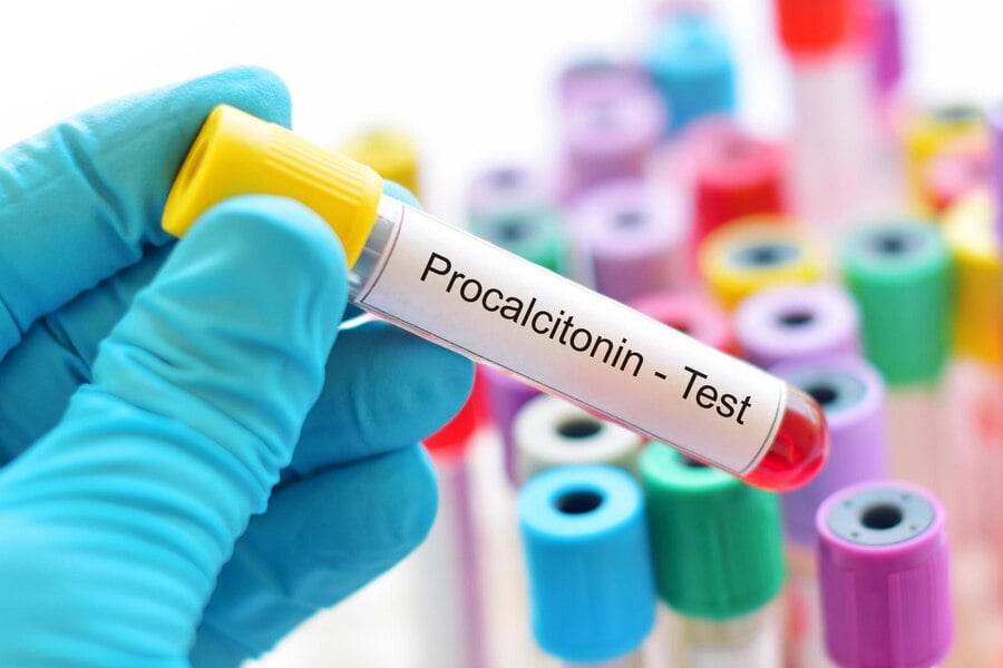 Изследване на прокалцитонин (PCT)