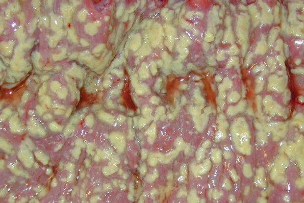 Ентероколит, предизвикан от Clostridium difficile Ентероколит, предизвикан от Clostridium difficile