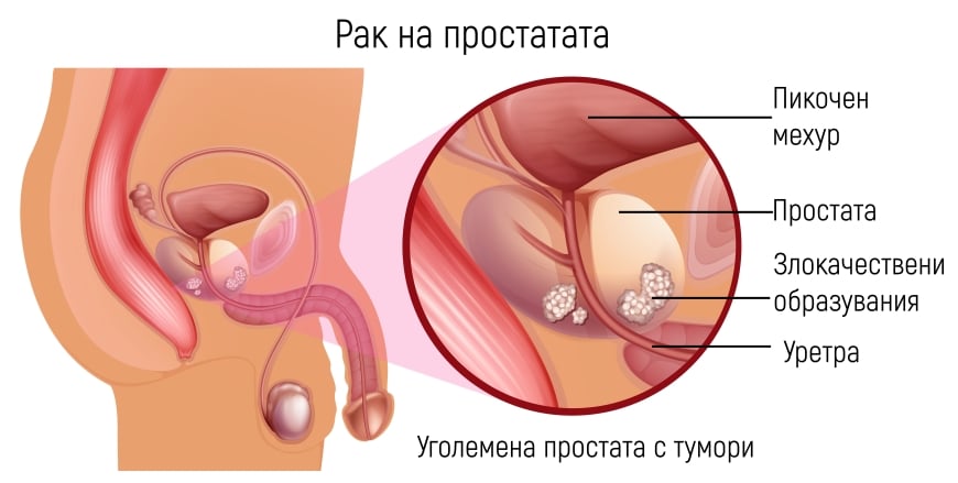 Рак на простатата 