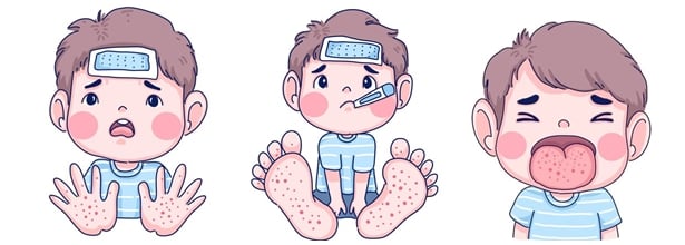 Характерни симптоми при заболяванто ръка-крак-уста