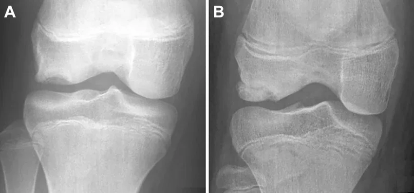 Рентгенова снимкам на дисекиращ остеохондрит Рентгенова снимкам на дисекиращ остеохондрит