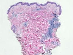 reticular erythematous mucinosis