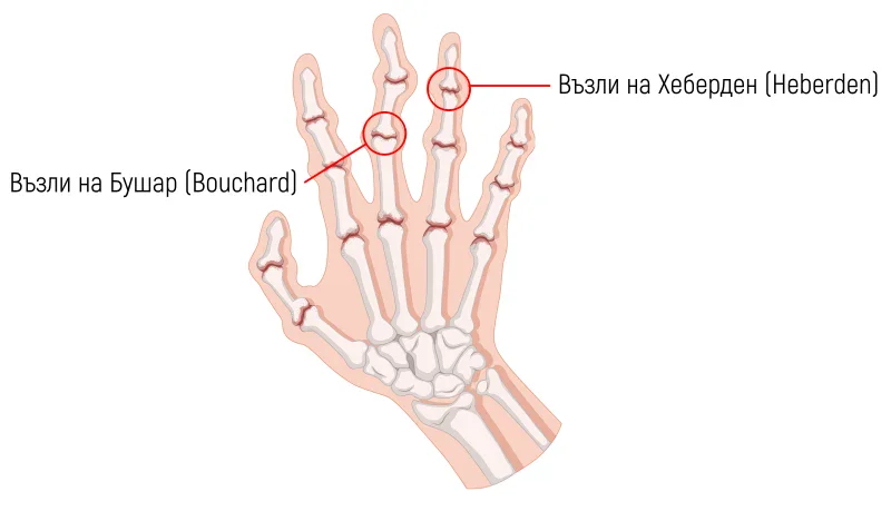Възли на Бушар и Хабендер при ревматоиден артрит Възли на Бушар и Хабендер при ревматоиден артрит