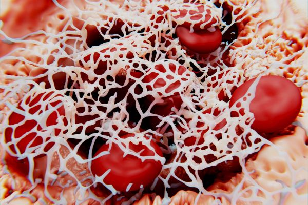 Спасяват крака на 82-годишен мъж, който е с исхемия на левия крак, страда от диабет и е с увреждане на бъбреците. исхемия на крайника