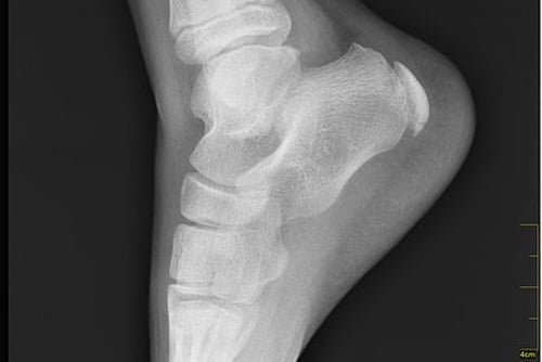 Рентгенова снимка на стъпалото при Болест на Северс