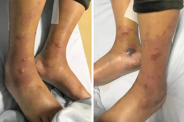    Vibrio vulnificus