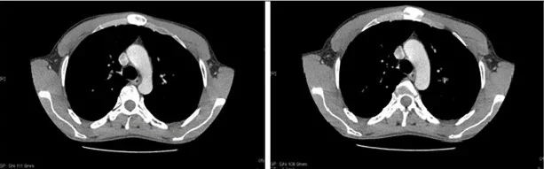 Компютърната томография на гръдния кош при синдром на Титце Компютърната томография на гръдния кош при синдром на Титце
