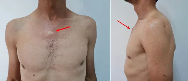 Снимка на пациент със синдром на Титце Снимка на пациент със синдром на Титце