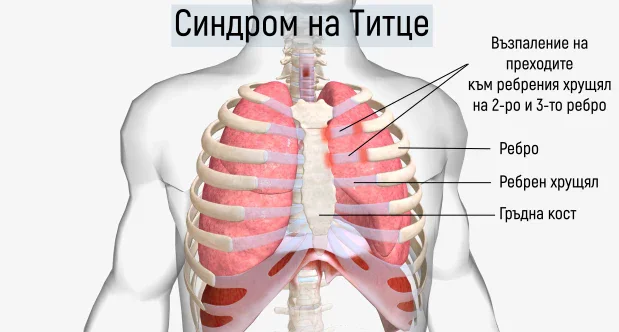 Засягане на ребрения хрущял при синдром на Титце Засягане на ребрения хрущял при синдром на Титце
