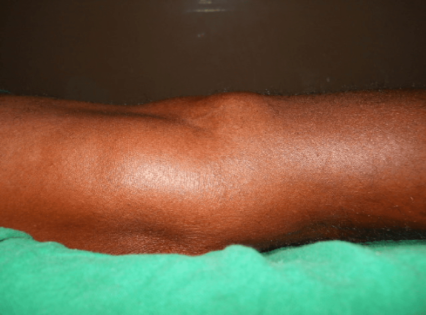 Снимка, показваща кисата на Бейкър Снимка, показваща кисата на Бейкър