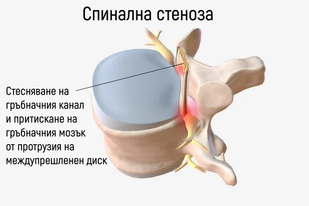 Спинална стеноза, причинена от дискова херния Спинална стеноза, причинена от дискова херния