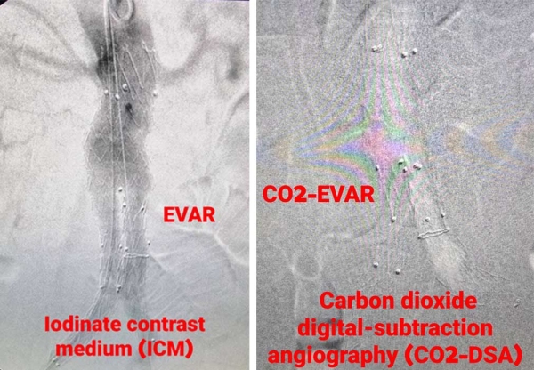 ���������-��������������� ����������� � ���������� ������� (CO2-DSA) � ��� ��-����� ���������� ������� ��� �������������� ������ ��������� (EVAR) � ������������ (����������) EVAR (F/B-EVAR).