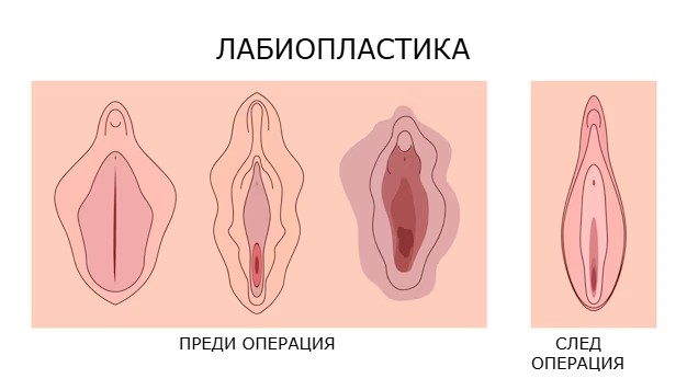 Лабиопластика Лабиопластика