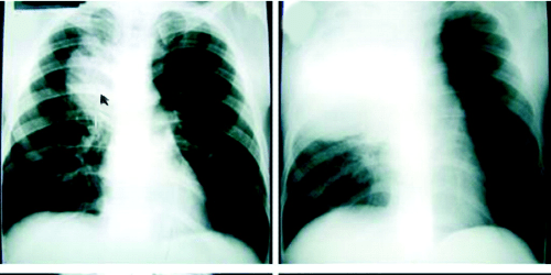 Pulmonary amebiasis