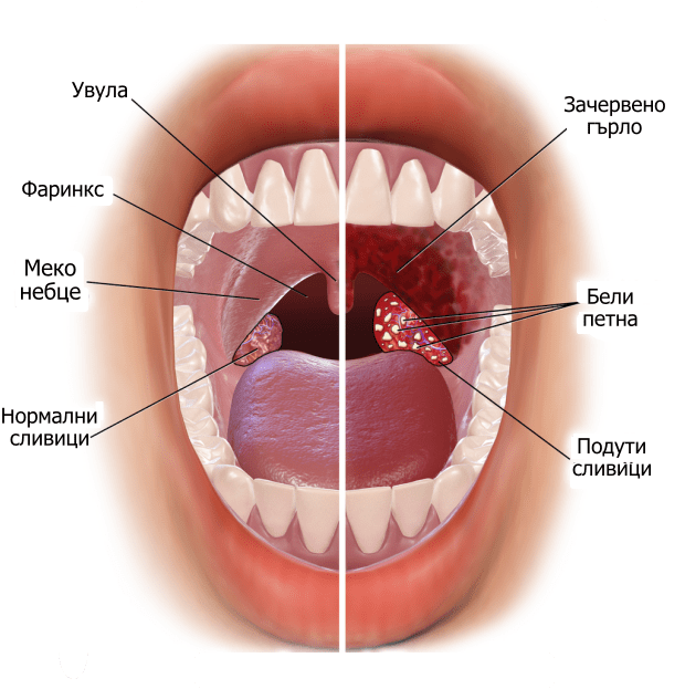 Тонзилит, причина за вкус на гной в устата Тонзилит, причина за вкус на гной в устата