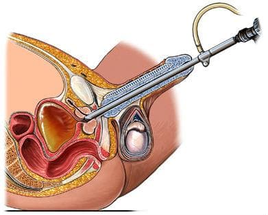 Трансуретрална биопсия на простатата