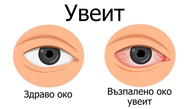 Увеит - възпаление на окото Увеит - възпаление на окото