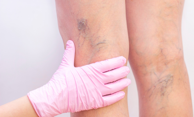 Склеротерапията е особено подходяща за малки повърхностни вени и видими капиляри, известни още като телеангиектазии, както и за фини мрежовидни венички. Склеротерапията е особено подходяща за малки повърхностни вени и видими капиляри, известни още като телеангиектазии, както и за фини мрежовидни венички.