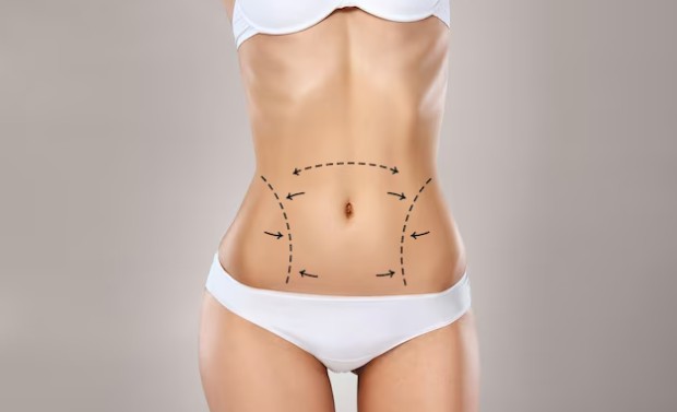 Възстановяване след абдоминопластика Възстановяване след абдоминопластика
