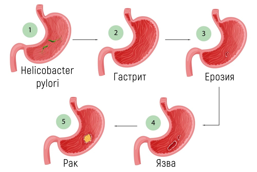   Helicobacter pylori 