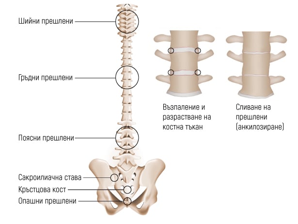 Засягане на гръбначния стълб при болест на Бехтерев