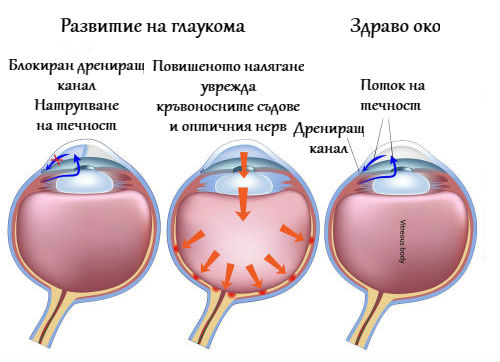 Что нельзя делать при глаукоме. Трабекулопластика при глаукоме. Селективная трабекулопластика при глаукоме. Индивидуальная норма глазного давления и глаукома. При глаукоме противопоказаны.