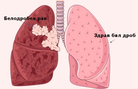 Leziya Izlizasha Izvn Granicite Na Edna I Poveche Posocheni Lokalizacii Na Bronha Ili Beliya Drob Mkb C34 8