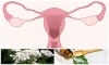 Киста на яйчника - лечение с билки и естествени средства