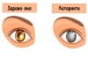 7 скрити признака на катаракта, с които може да се сблъскате, без да подозирате