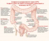13 факти, които вероятно не знаете за синдрома на раздразненото черво (инфографика)