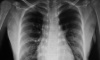Q67.6 Pectus excavatum