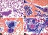 Клинична патология на грануломатозен тиреоидит