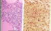 Клинична патология на остър тиреоидит
