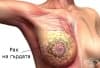 Клинична патология при злокачествени заболявания на гърдата