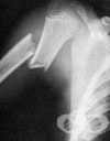 Рентгеново изследване на раменната кост