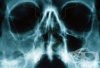 Рентгеново изследване на носната кухина